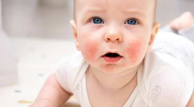 Baby Skin Problems